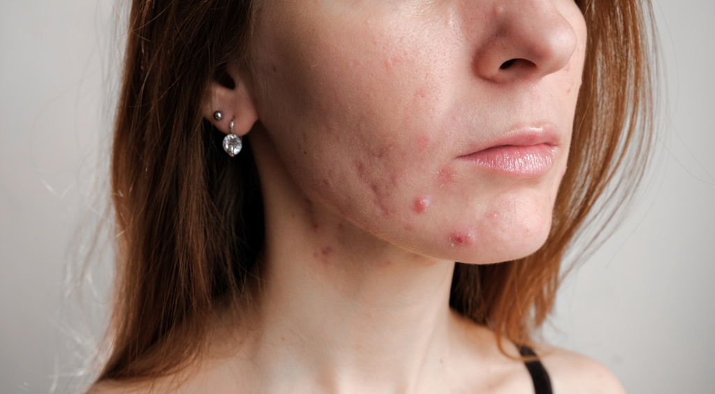 Image of a woman examining her acne in the mirror, highlighting the connection between blood sugar regulation and skin health.